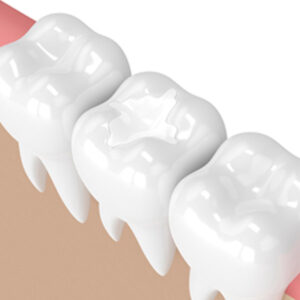 White Fillings in Surrey